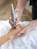 cryopen treatment wimbledon and kensington