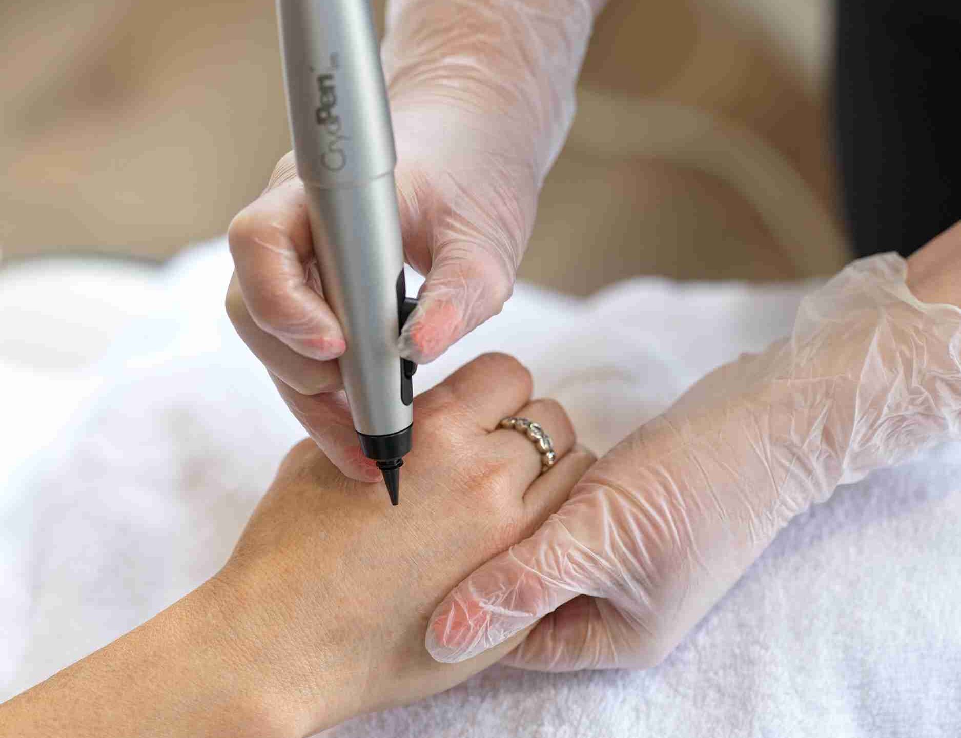 cryopen treatment wimbledon and kensington
