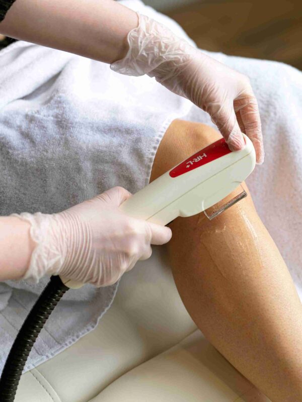 laser hair removal London