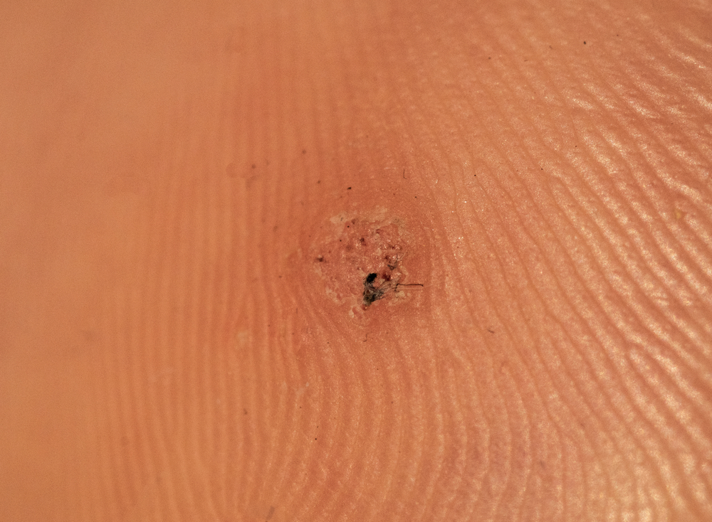 verruca & wart treatments London