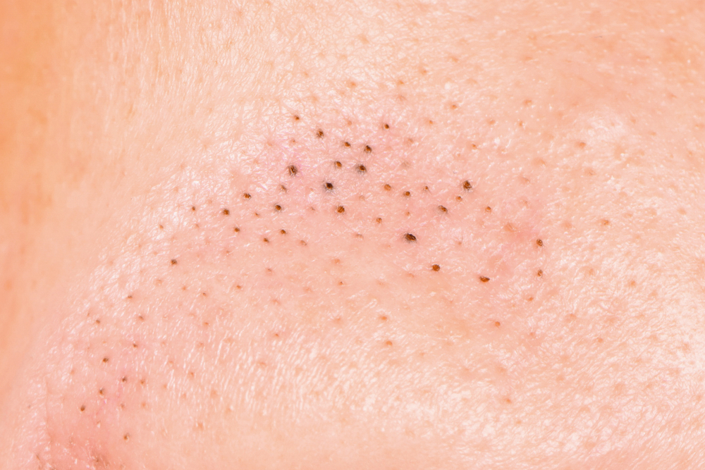 blackhead-treatments-london