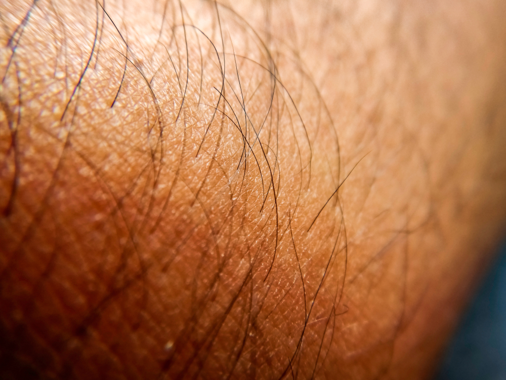 excess hair treatments kensington