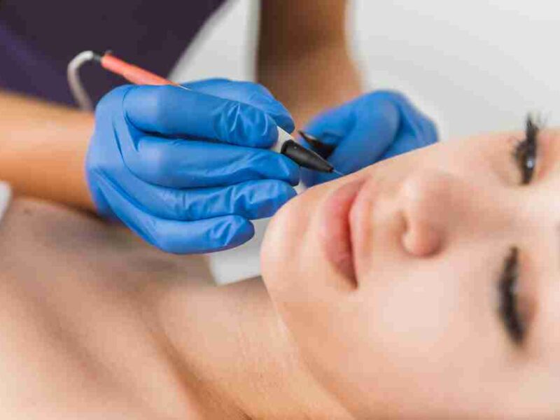 Is Electrolysis Hair Removal Safe for the Face?