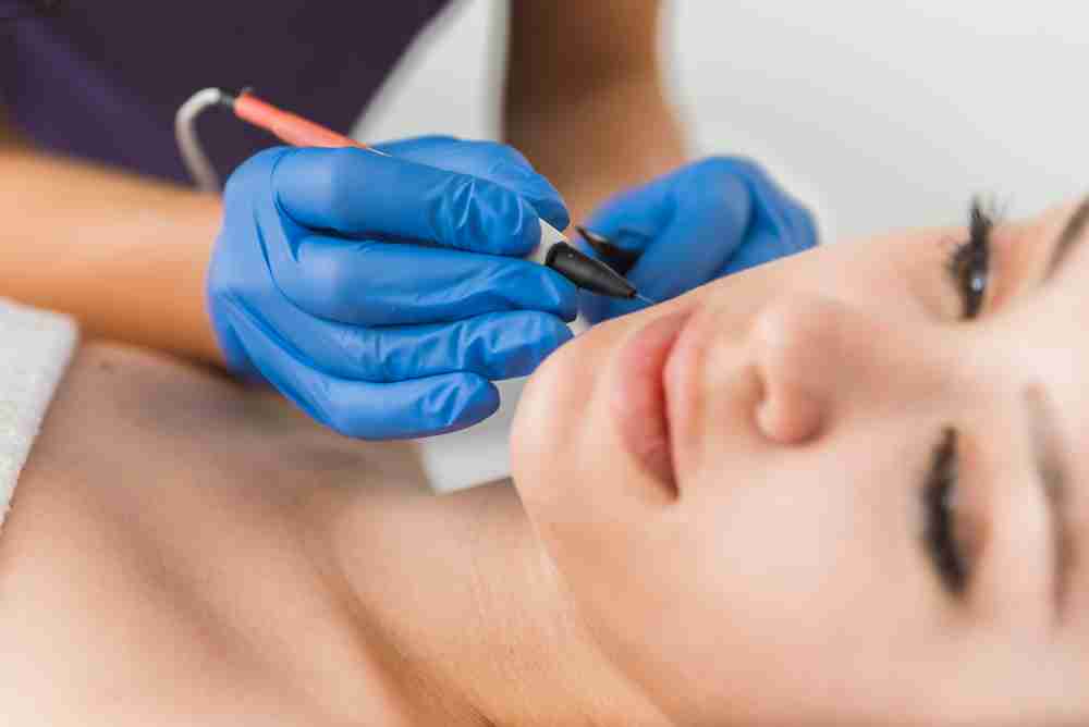 Is Electrolysis Hair Removal Safe for the Face? 