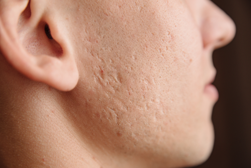 acne scarring treatments Wimbledon & Kensington