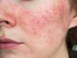 Rosacea treatments local to me wimbledon