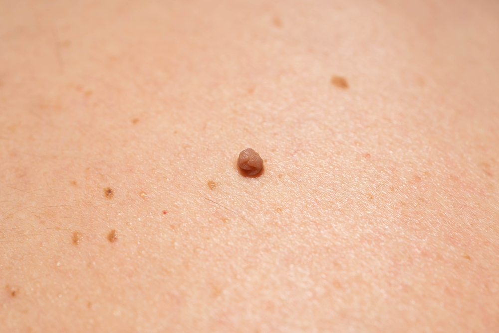 skin tag treatment London