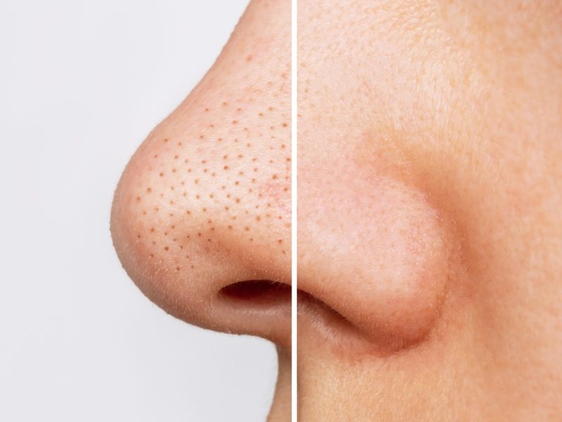 What causes Blackheads?