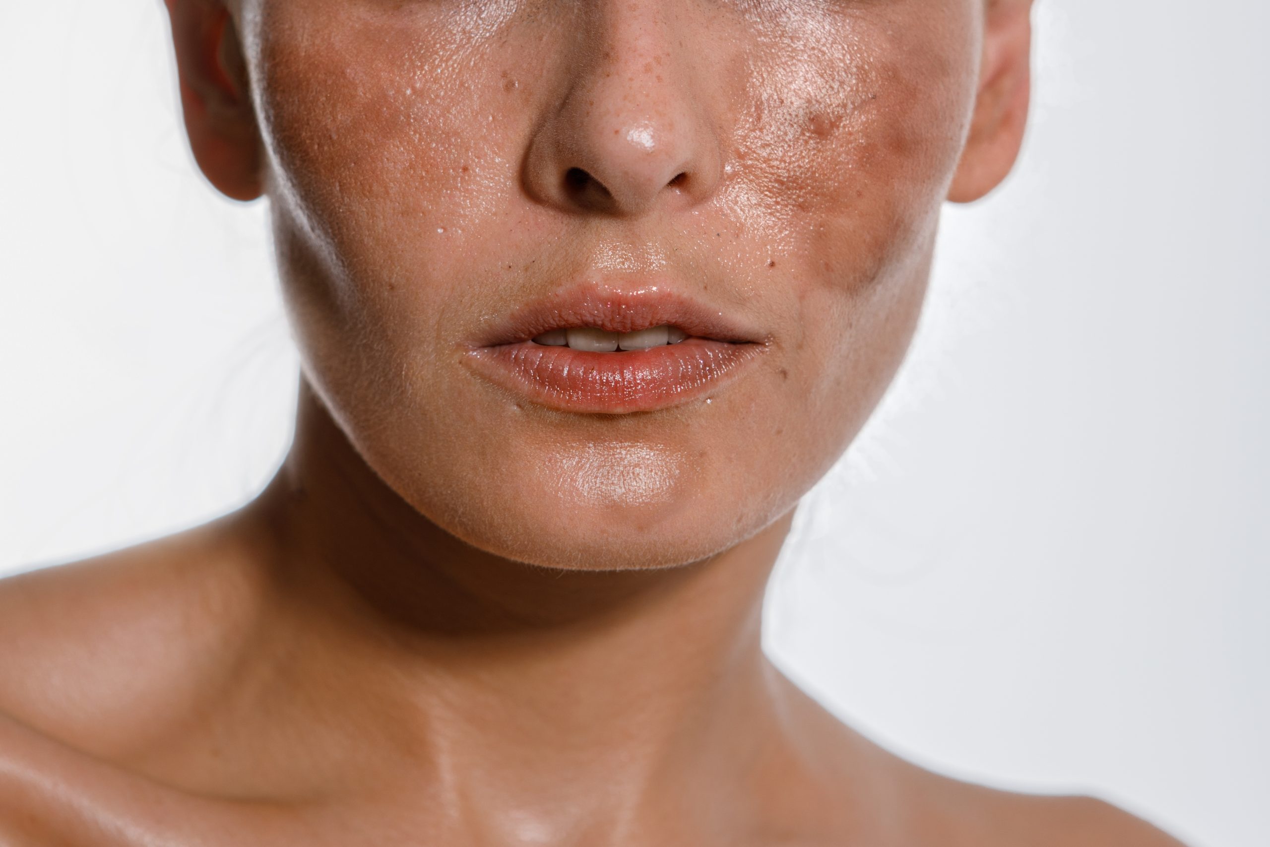 skin pigmentation treatment