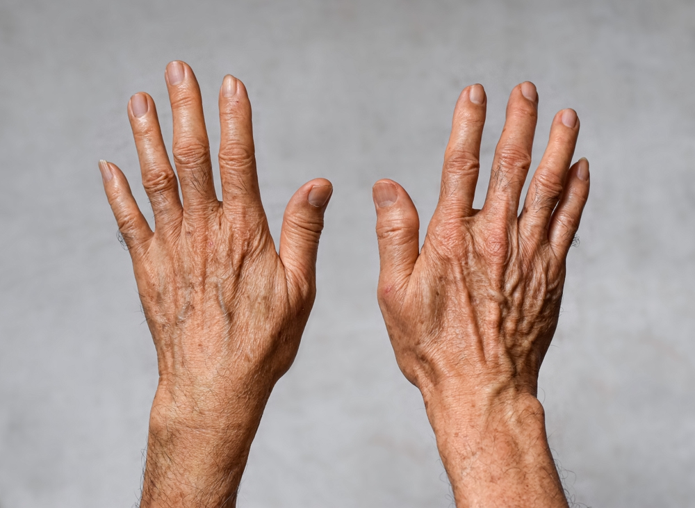 aging hand treatments Kensington