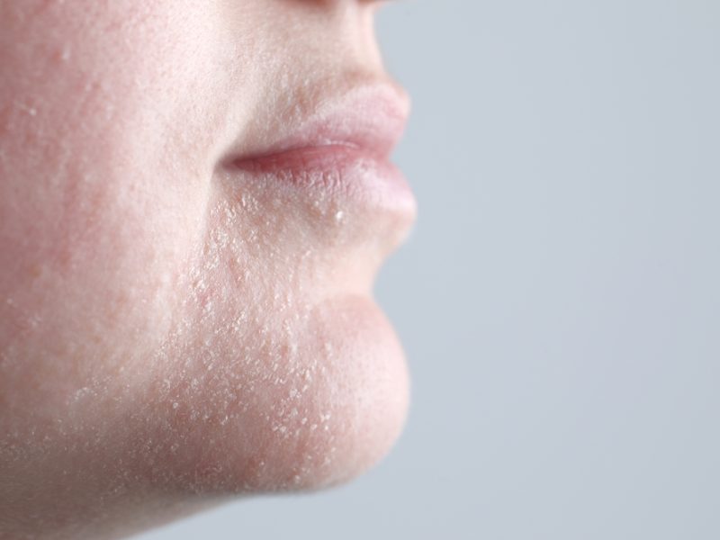 Can Dehydrated Skin Cause Wrinkles?