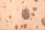 Seborrhoeic Keratosis london