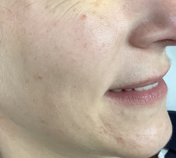 dull skin treatments wimbledon & kensington