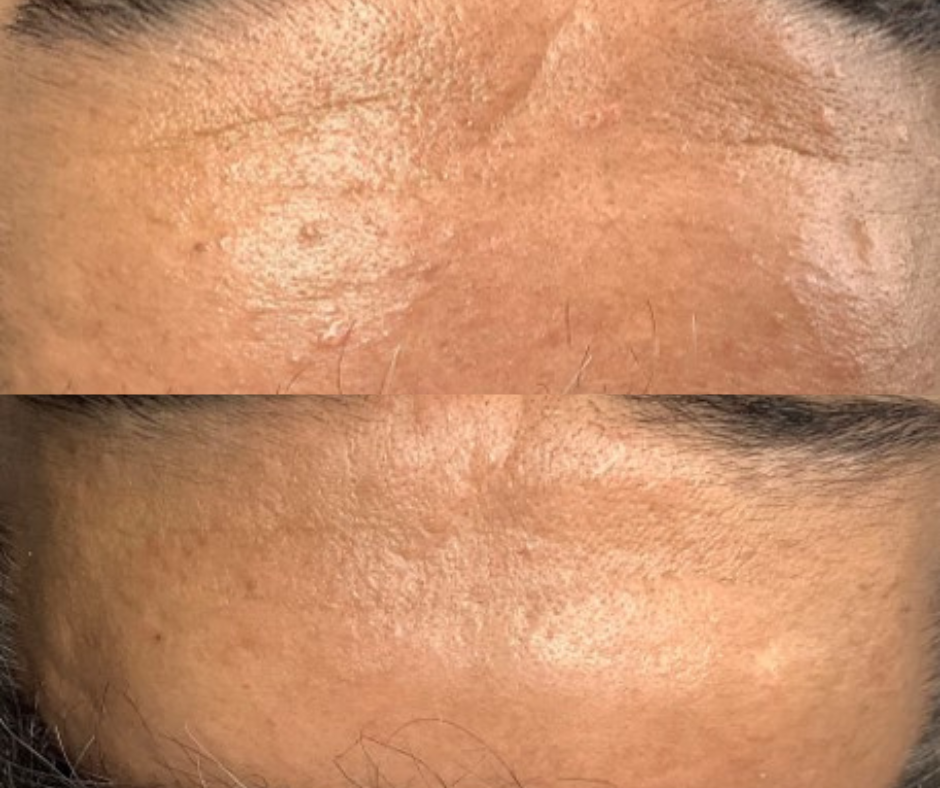 Sebaceous hyperplasia treatments London