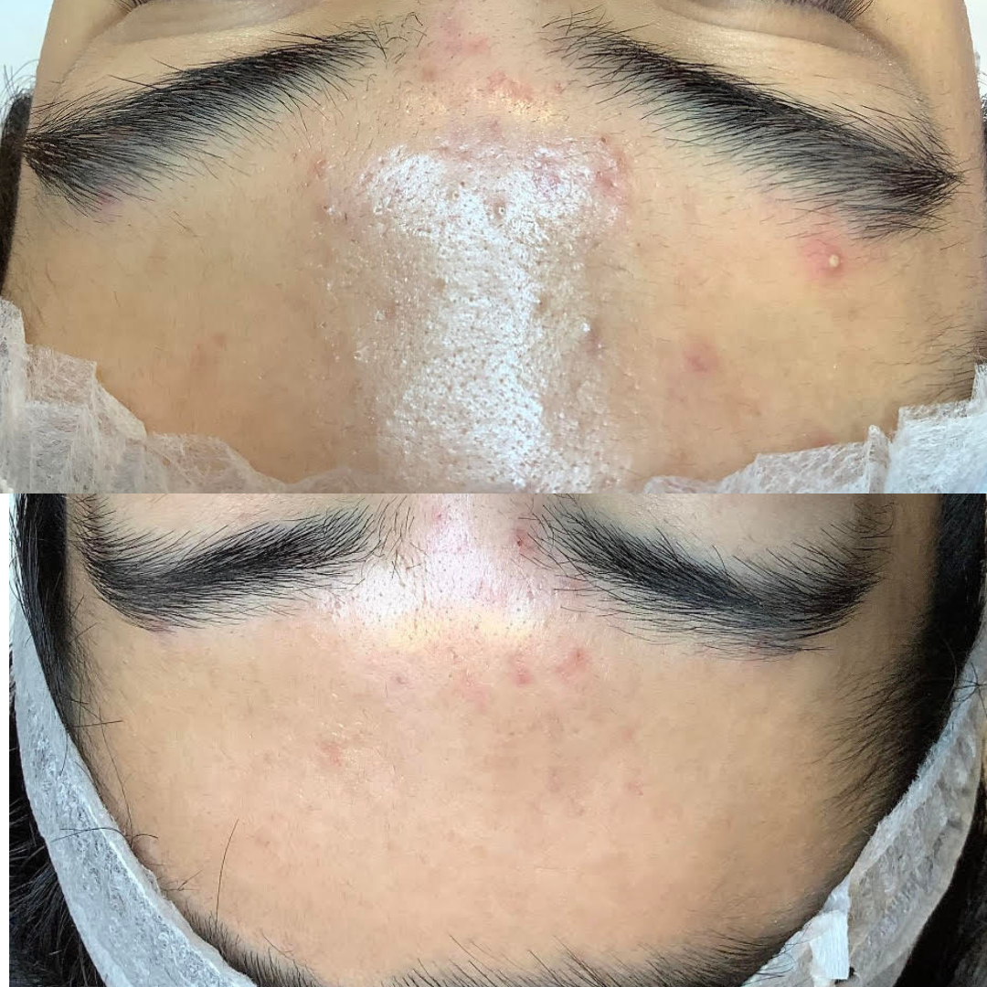 congested skin treatments London