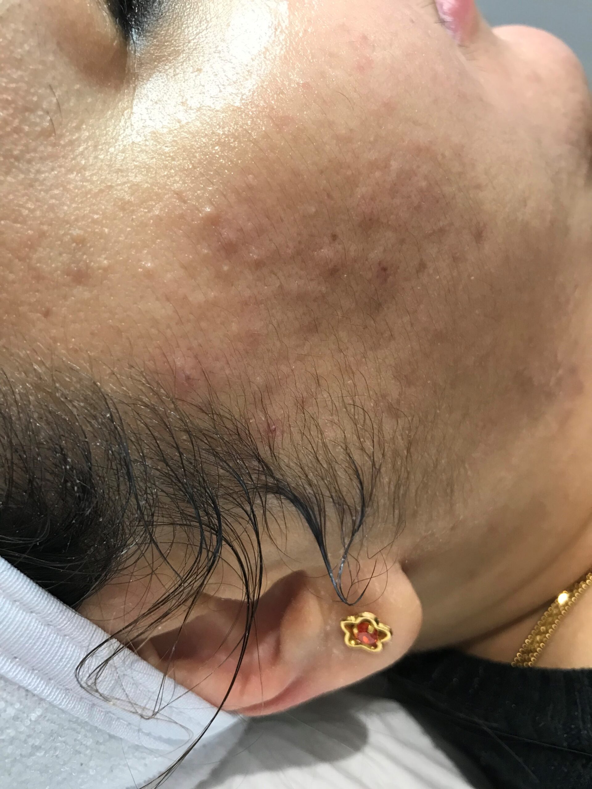 Closed Comedones Removal Treatment London