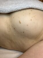 Seborrhoeic keratosis treatments near me