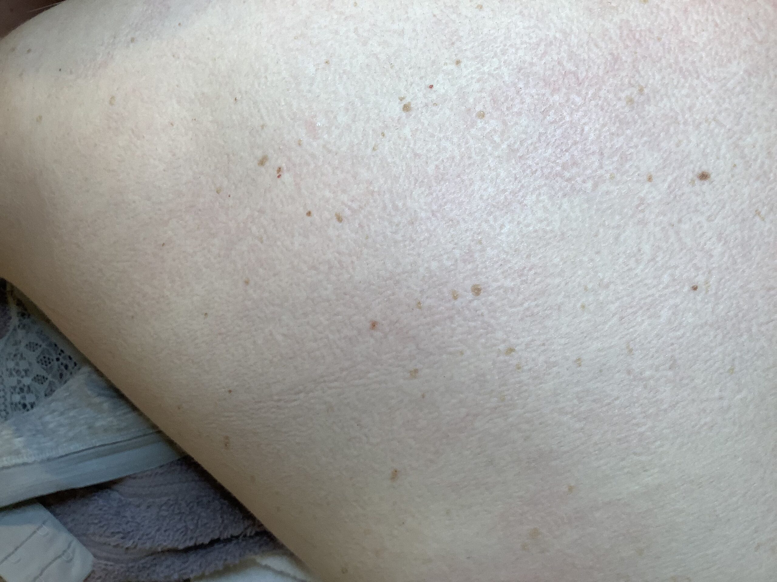 Seborrhoeic keratosis treatments London