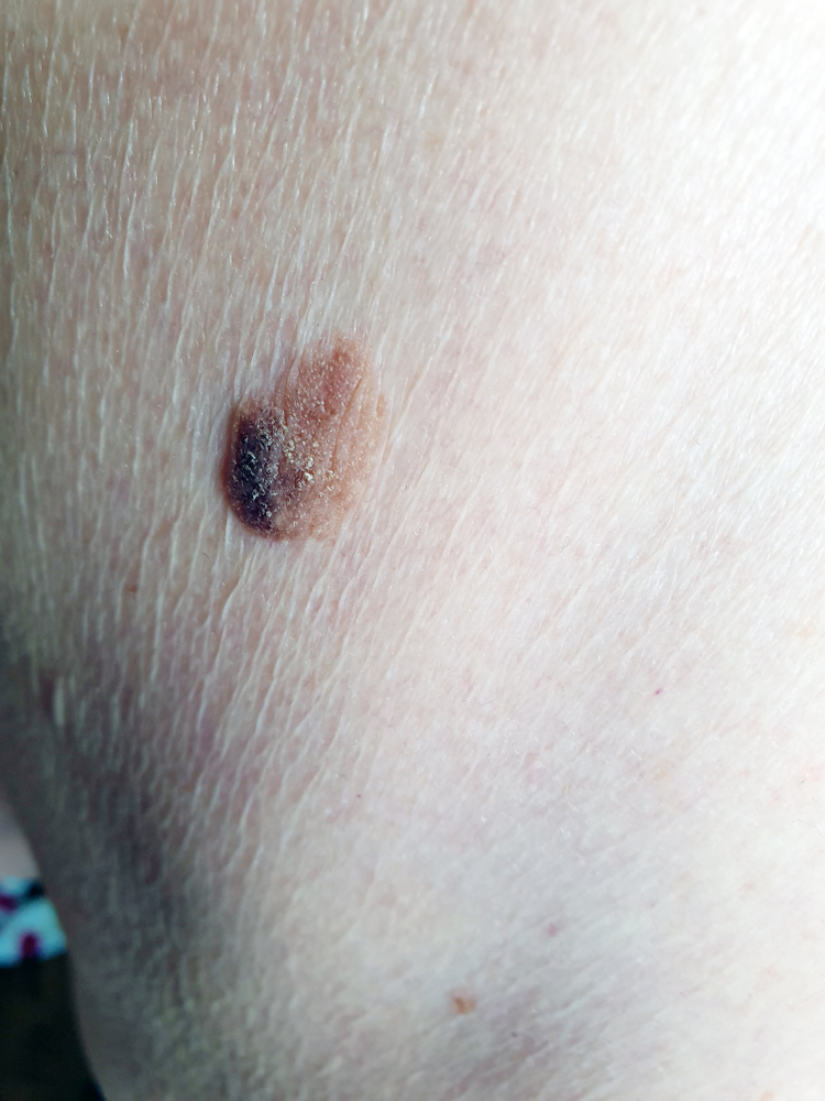 Seborrhoeic keratosis skin clinic London