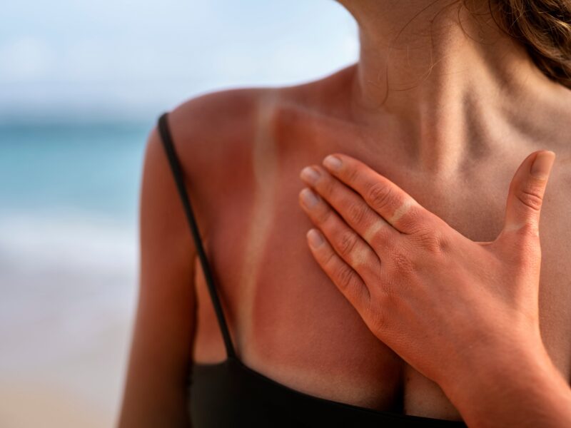 Our Recommended Treatments for Sun Damage