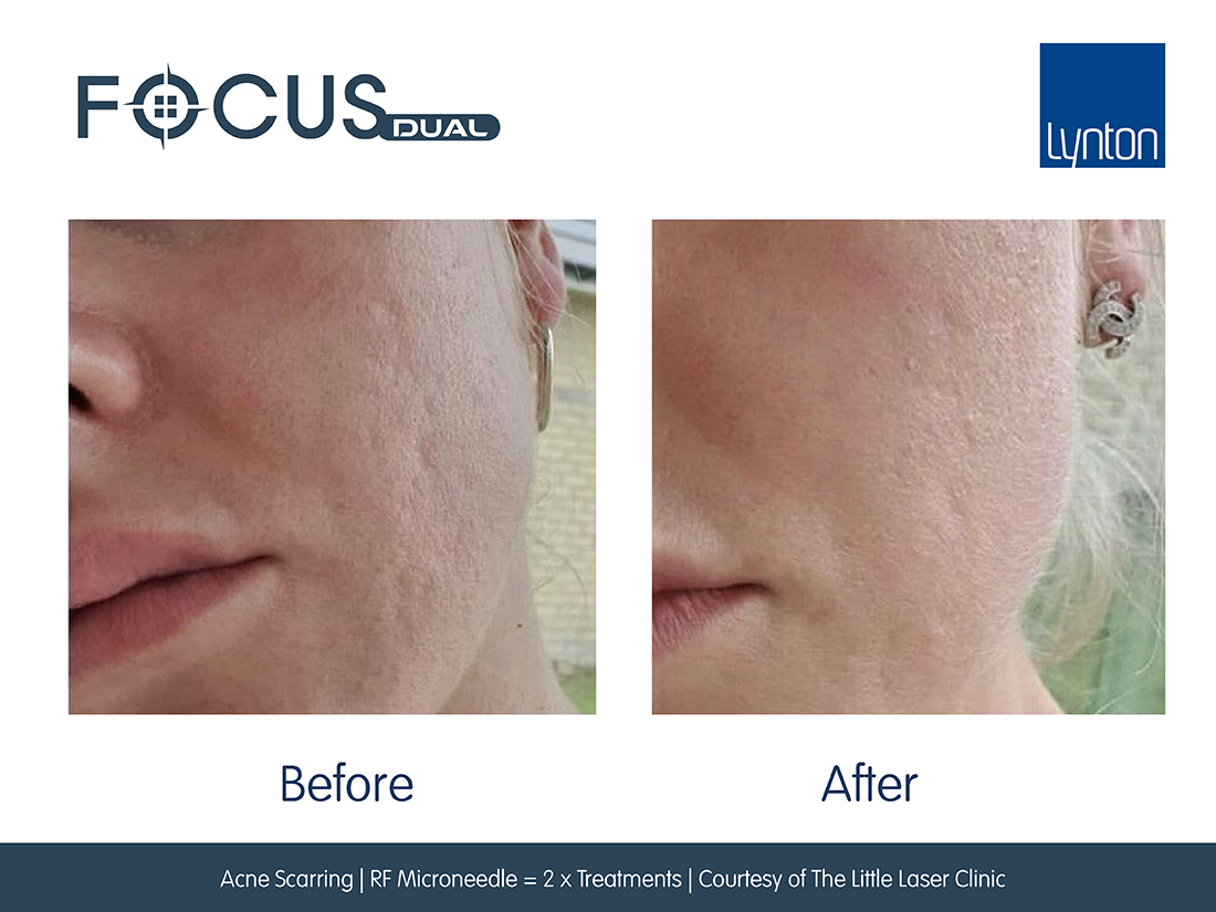 RF microneedling before and after