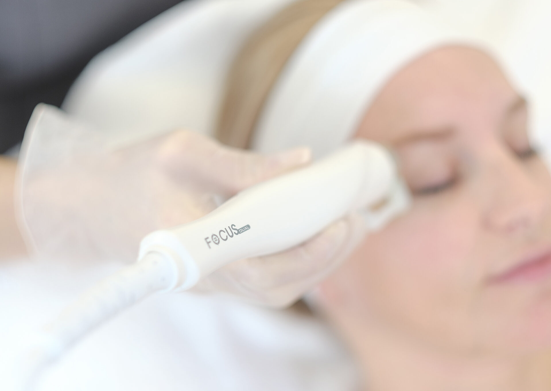 RF microneedling before and after