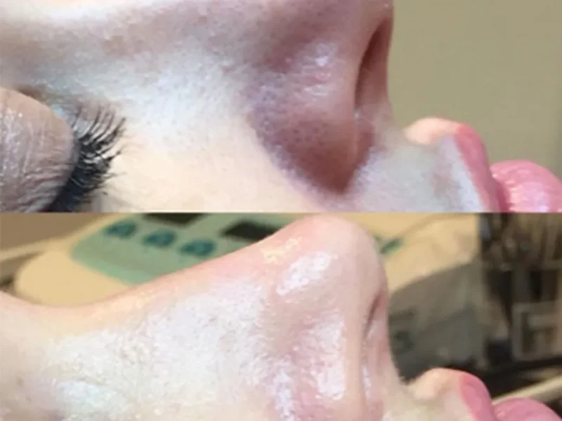 Everything You Need to Know About Ameson Mesopeel Chemical Peels