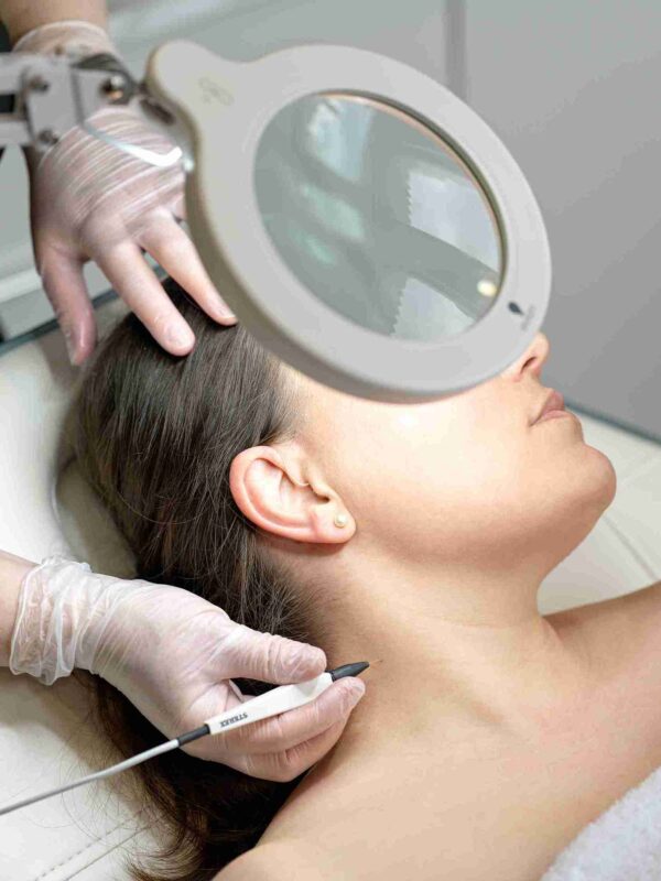 electrolysis for cherry angiomas