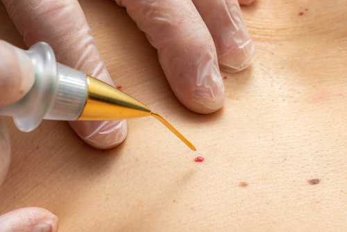 Removal Methods for Cherry Angiomas