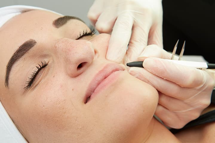 Electrolysis Hair Removal