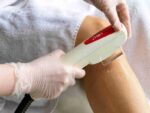 IPL Hair Removal