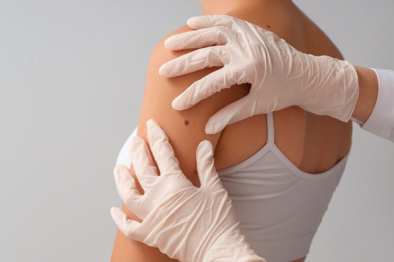 Why Mole Mapping Should Be Part of Your Skin Health Routine