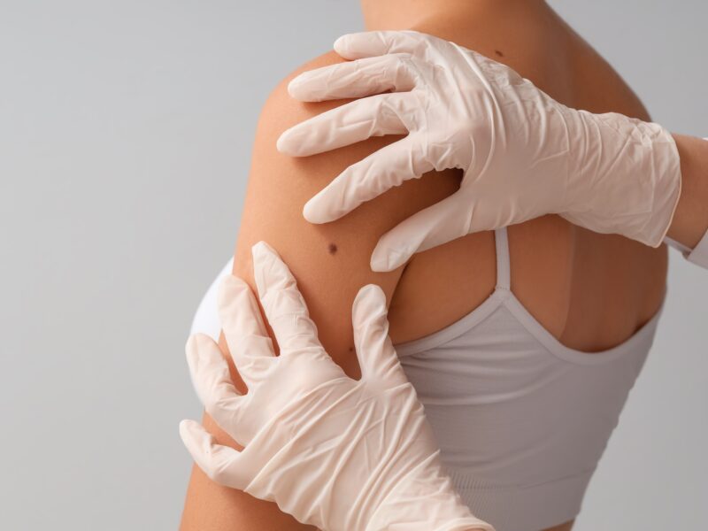 Why Mole Mapping Should Be Part of Your Skin Health Routine