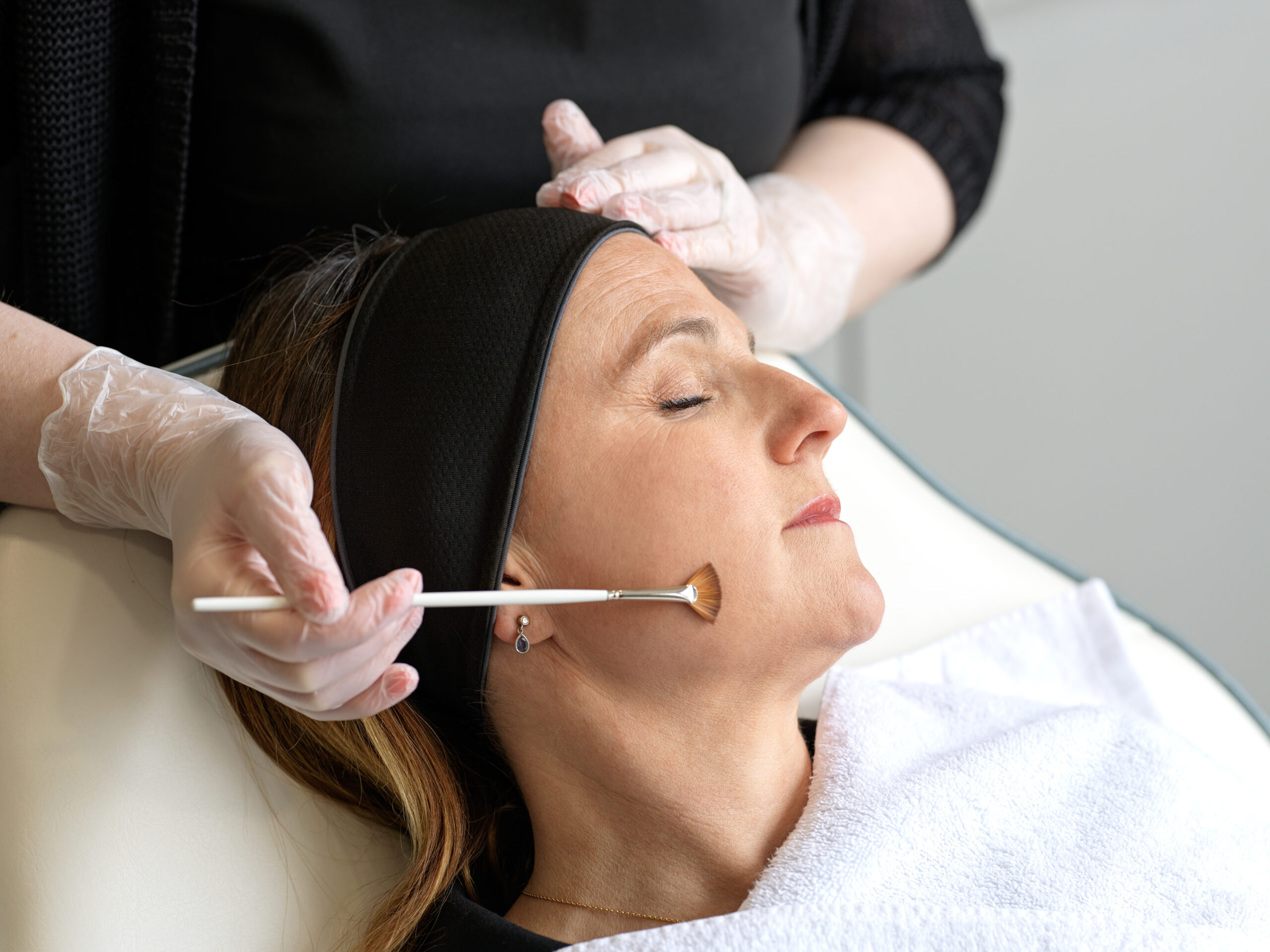 Radio frequency microneedling London