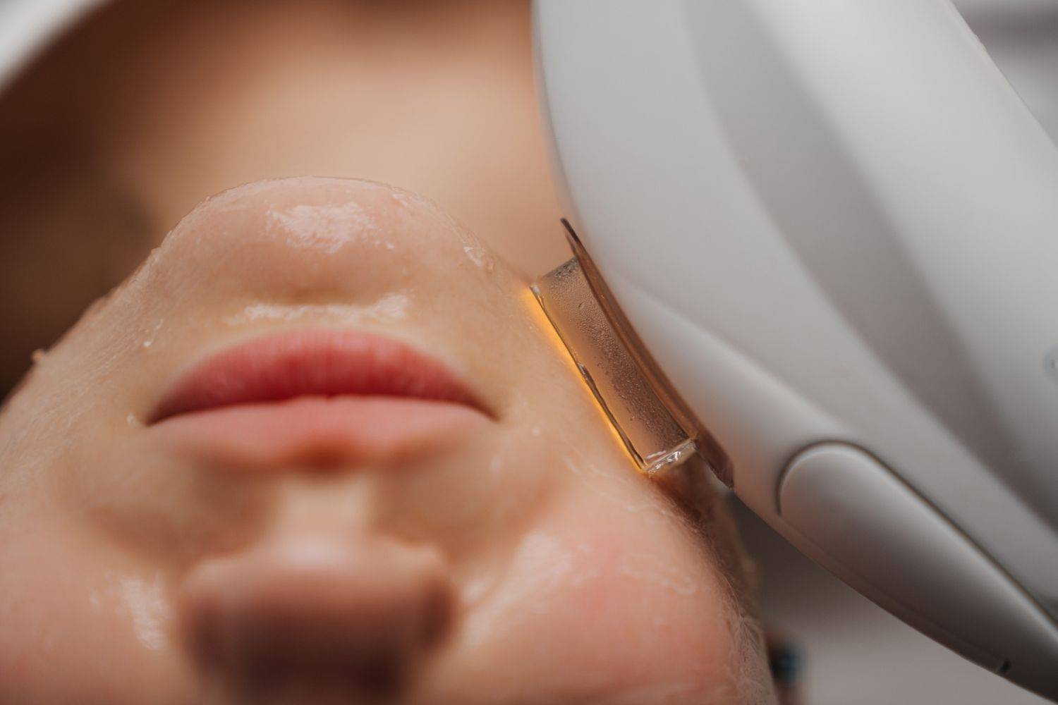 Benefits Of IPL Treatments In Wimbledon