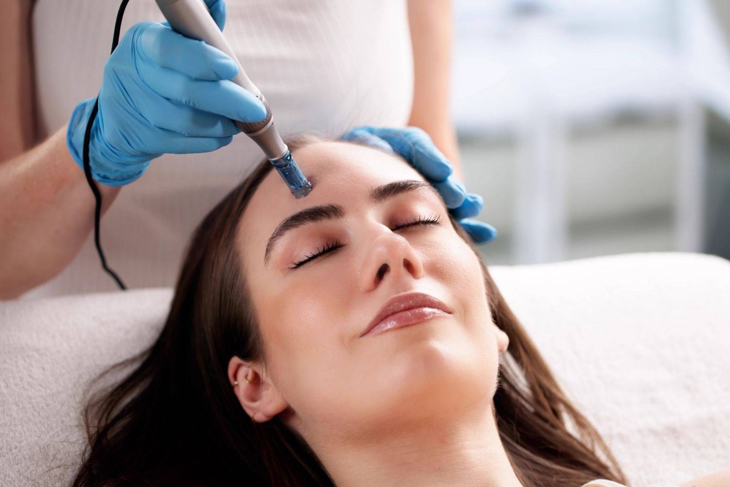 Why Consider Micro Needling Treatments In Raynes Park?