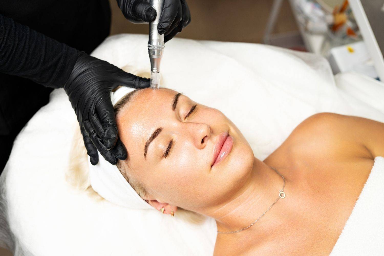 Benefits Of Micro Needling Treatments For Raynes Park Residents