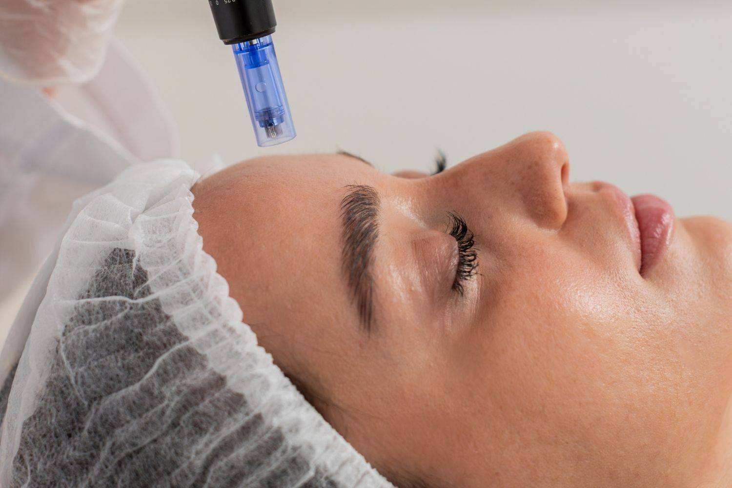 Advanced Micro Needling Techniques In Raynes Park