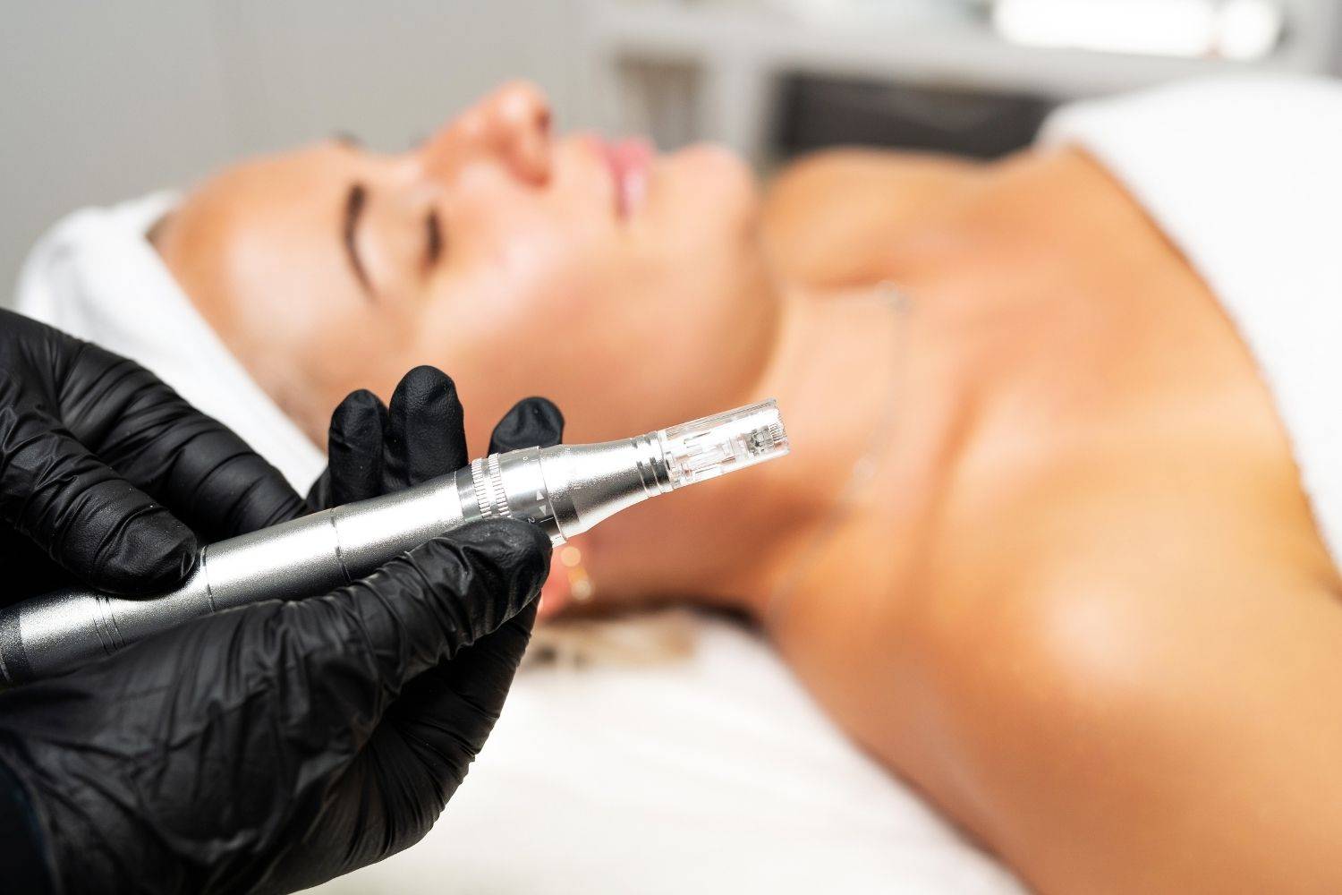 Experience The Transformative Effects Of Micro Needling In Raynes Park