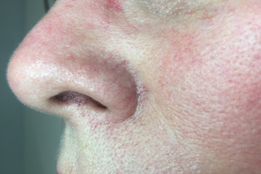 red veins around nose