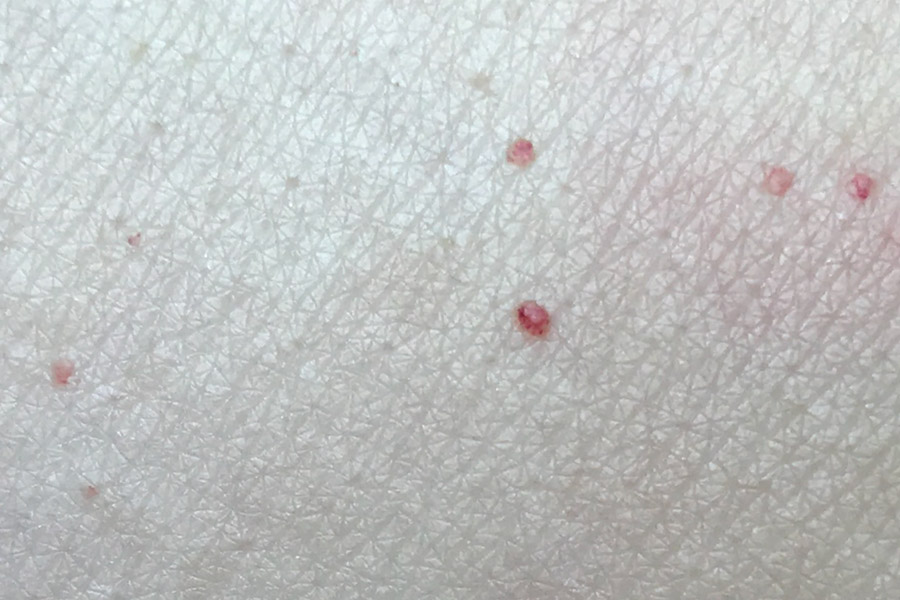 Cherry Angioma Bleeding Nhs Cherry Angioma Aesthetics Of London