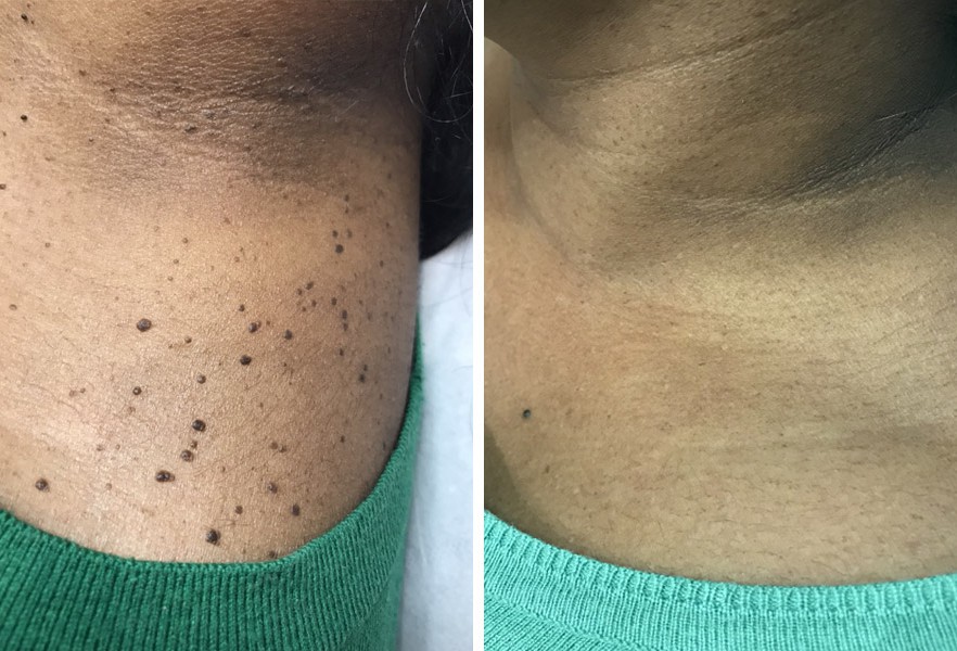 Kensington & Wimbledon Advanced Electrolysis Treatments