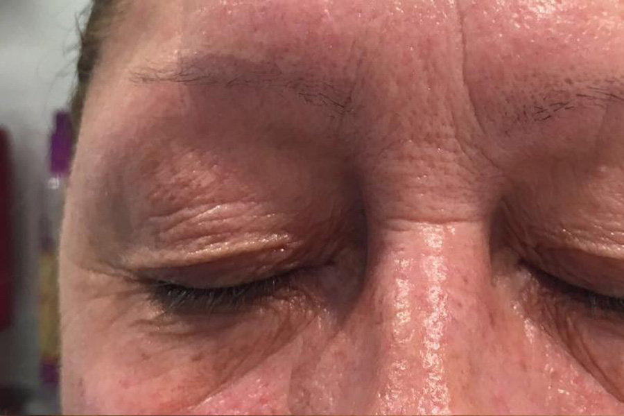 Heavy Droopy Eyelids Treatment Kensington Wimbledon Skin Clinics