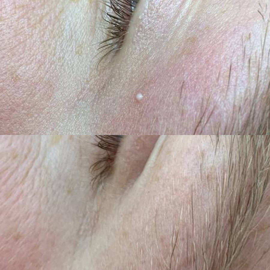 Milia Treatments London Skin Clinic Kensington