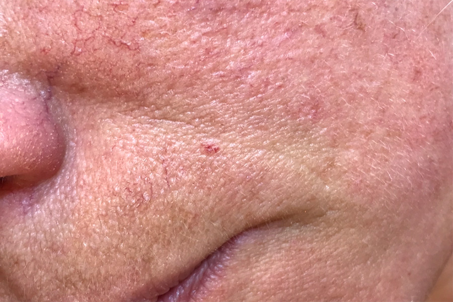 Slow Triggers For Rosacea