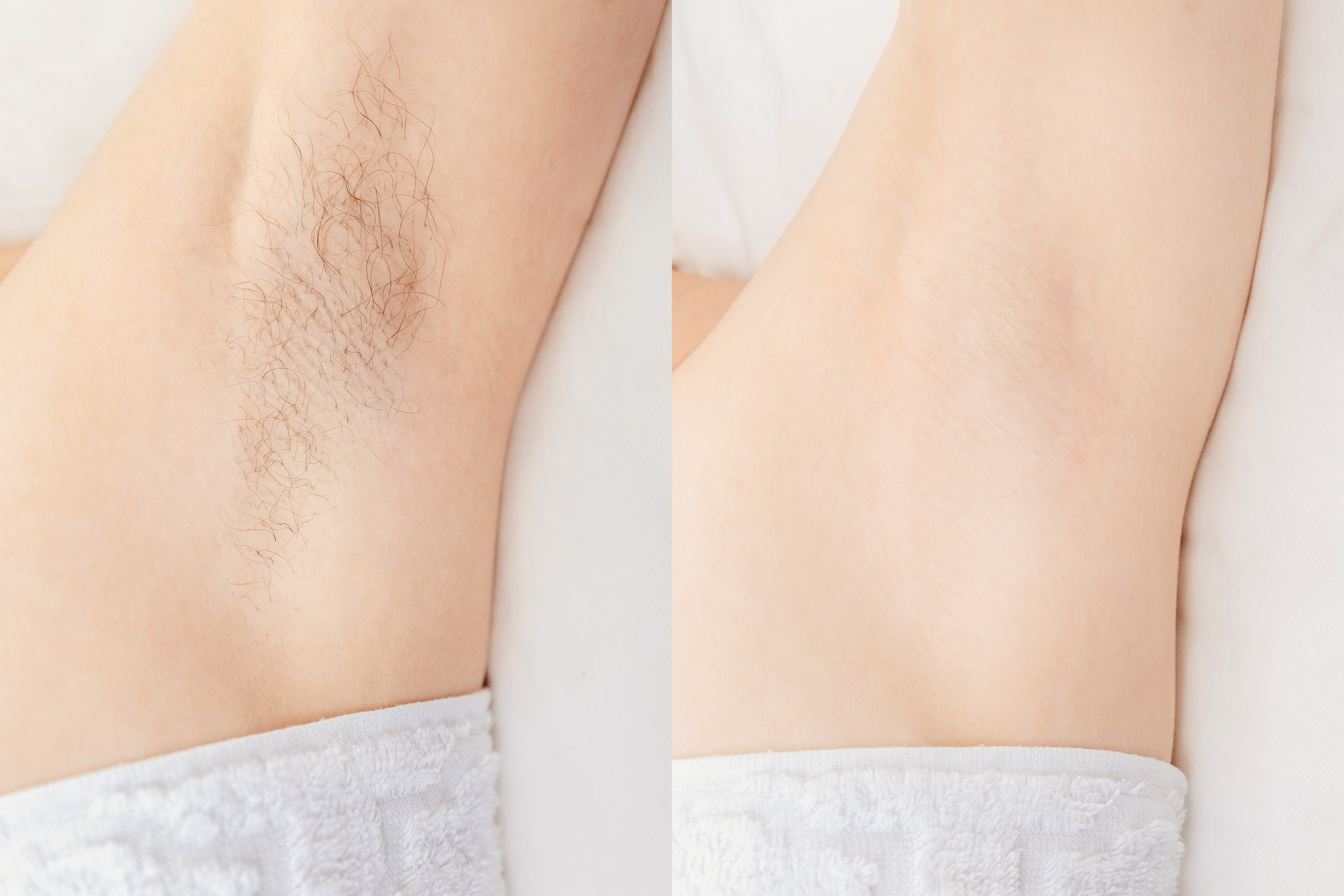 Excess/Unwanted Hair