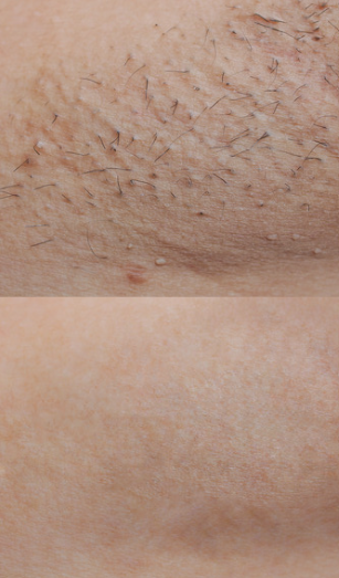 Ingrown Hair Treatments Ingrown Hair Treatments