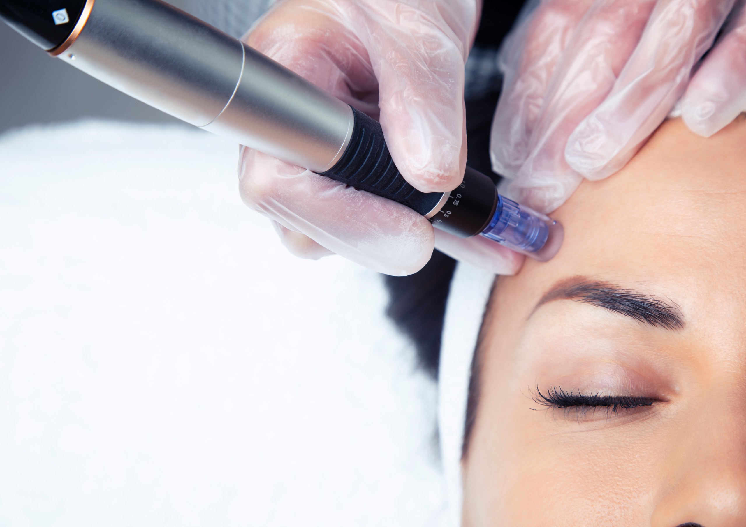 What Does Micro-Needling Do? What Does Micro-Needling Do?